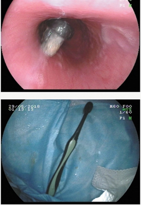從食道里取出的牙刷.